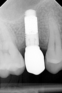 implantologie implantat knochen künstliche Würzeln protetische Zähne Osseointegration Studio Bianconi Zahnarzt Bozen