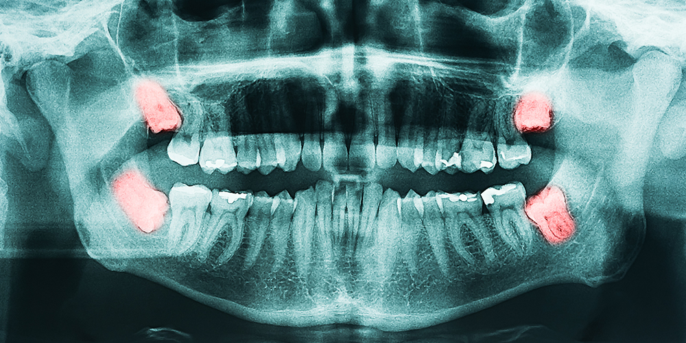 Chirurgia dente del giudizio eruzione parziale Studio Bianconi dentista Bolzano
